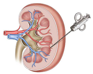 Kidney Biopsy/ Renel Biopsy